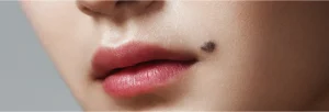 خال و زگیل ندای سلامت