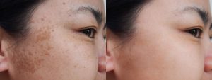 لیزر کیوسوئیچ ندای سلامت