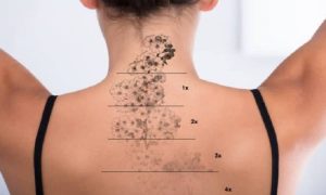 پاک کردن تتو ندای سلامت