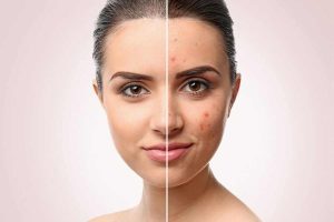 جوش بعد از لیزر در کلینیک ندای سلامت
